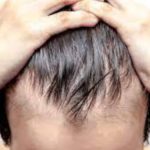 What Causes Baldness