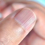 fingernail ridges