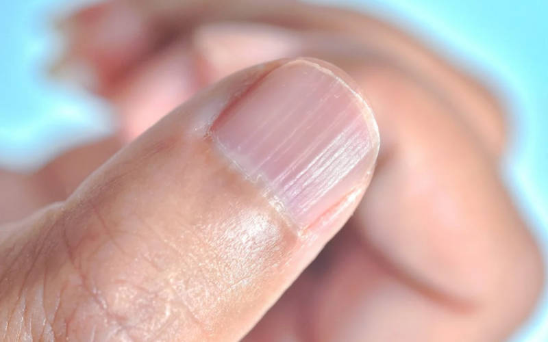 fingernail ridges